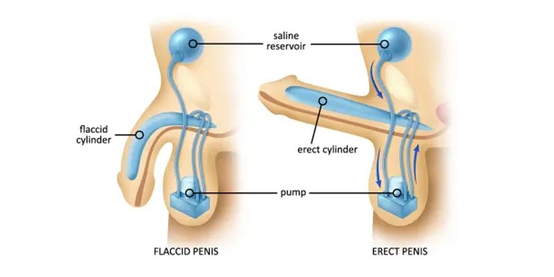 Erectile Dysfunction Treatment In Balod
